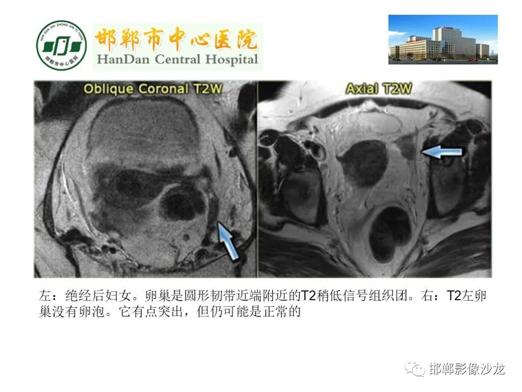 【PPT】卵巢非肿瘤性病变的影像诊断-10