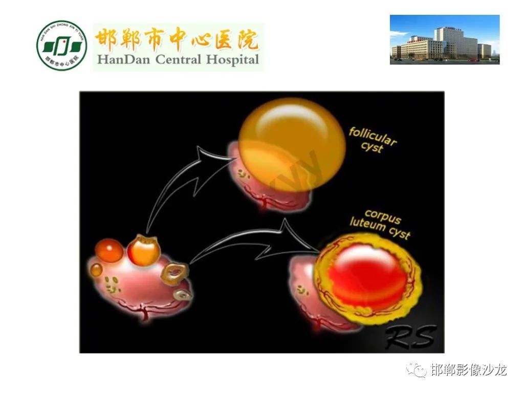 【PPT】卵巢非肿瘤性病变的影像诊断-12