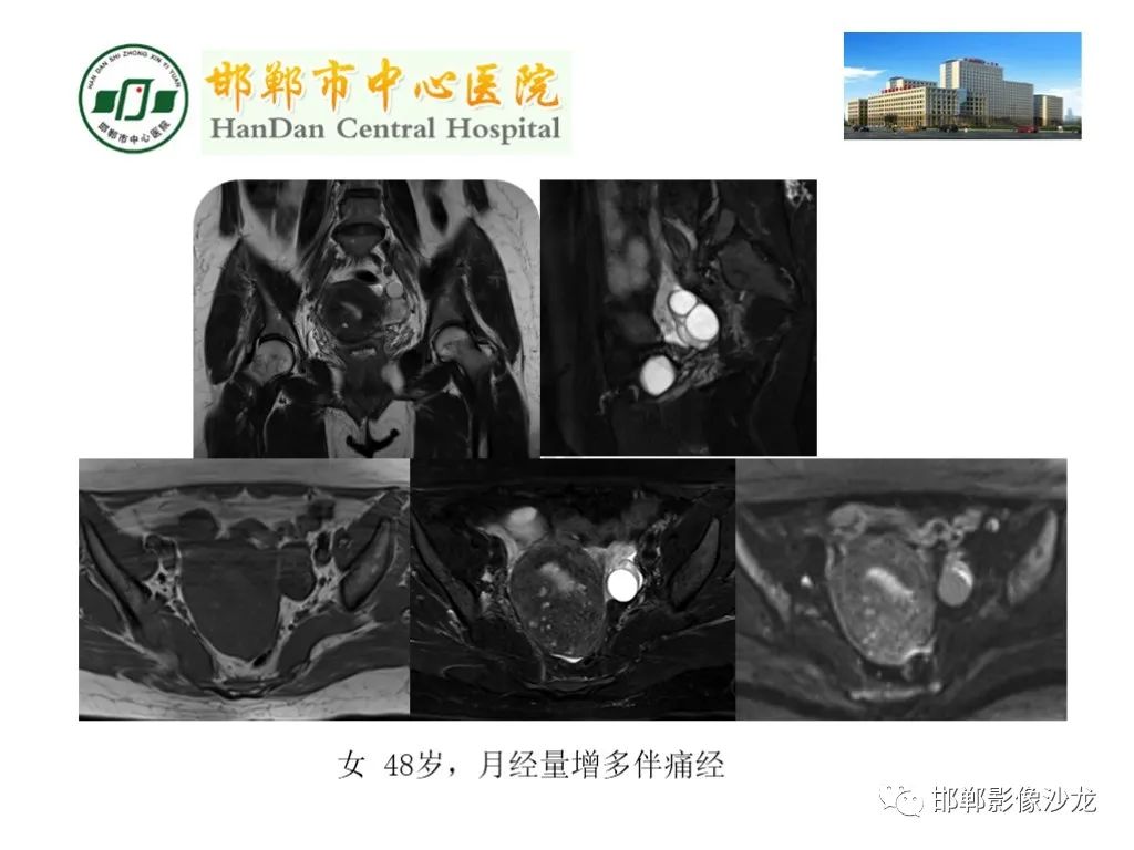 【PPT】卵巢非肿瘤性病变的影像诊断-14