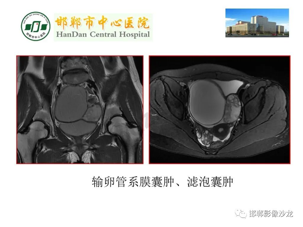 【PPT】卵巢非肿瘤性病变的影像诊断-15