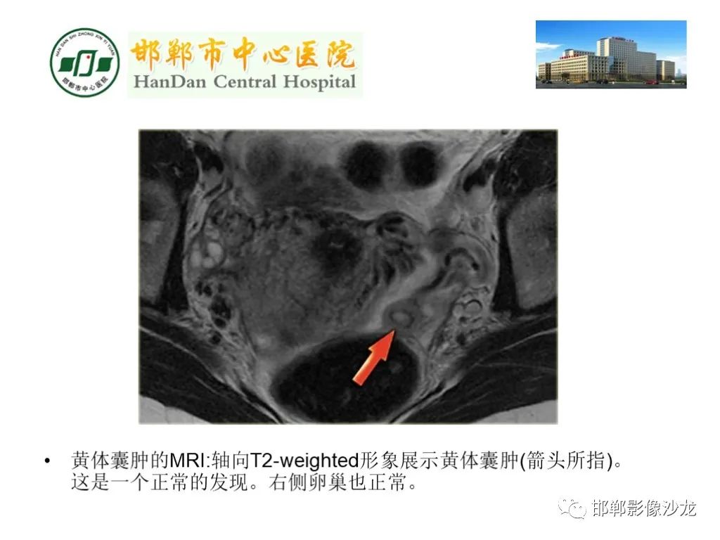 【PPT】卵巢非肿瘤性病变的影像诊断-17