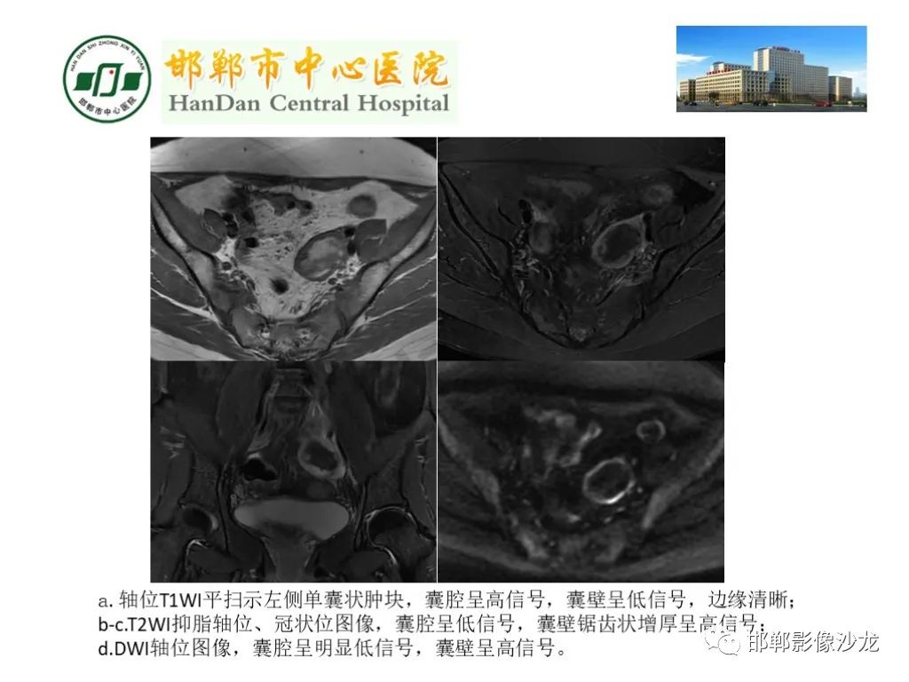 【PPT】卵巢非肿瘤性病变的影像诊断-18