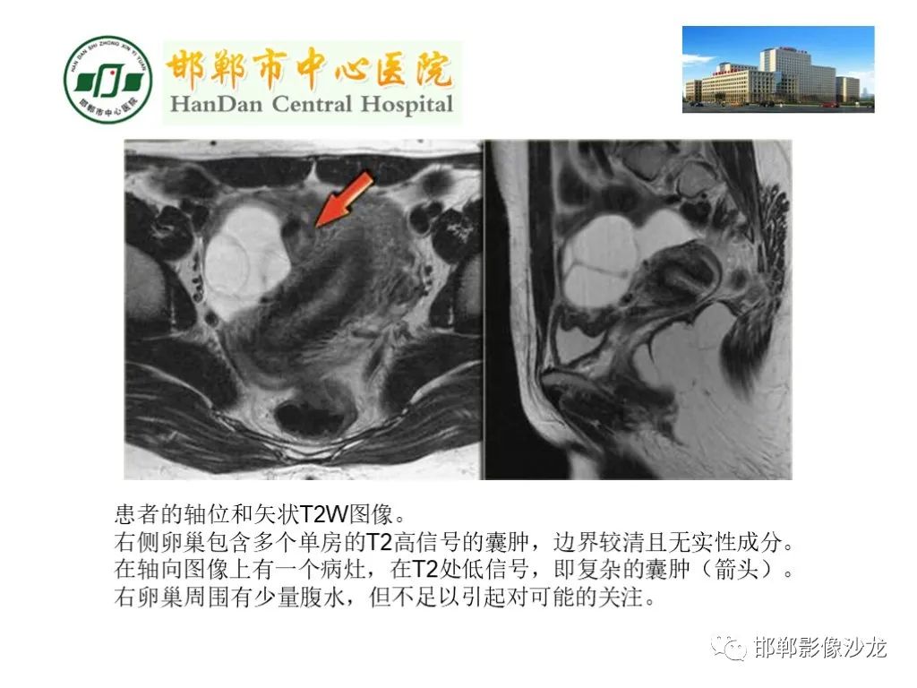 【PPT】卵巢非肿瘤性病变的影像诊断-20