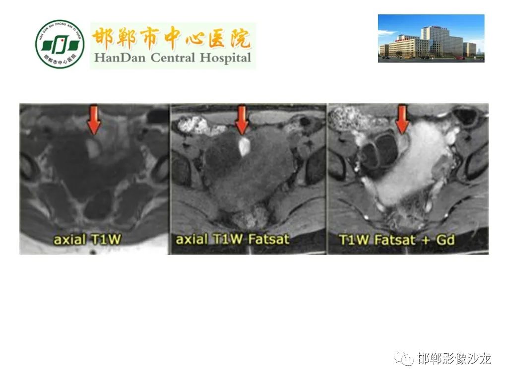 【PPT】卵巢非肿瘤性病变的影像诊断-21