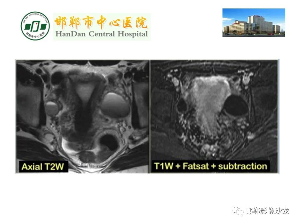 【PPT】卵巢非肿瘤性病变的影像诊断-22