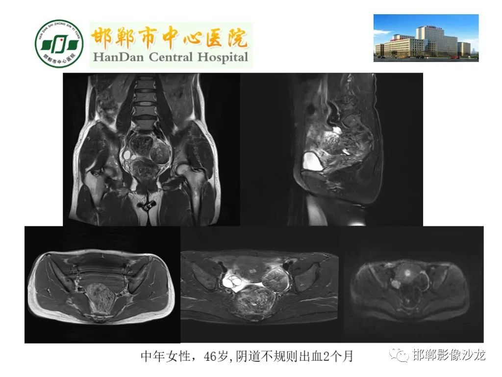 【PPT】卵巢非肿瘤性病变的影像诊断-23