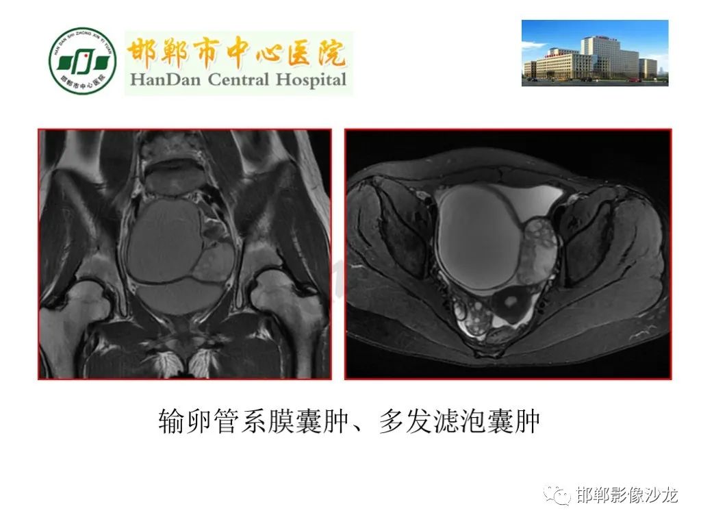 【PPT】卵巢非肿瘤性病变的影像诊断-25
