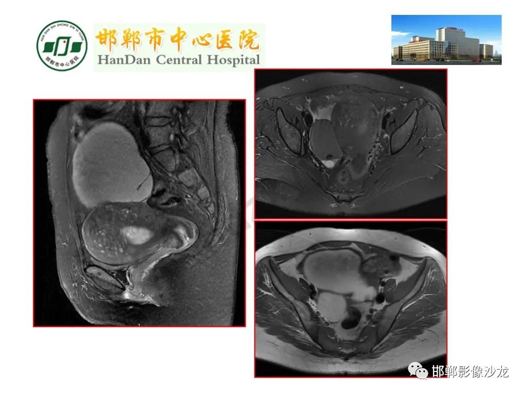 【PPT】卵巢非肿瘤性病变的影像诊断-27