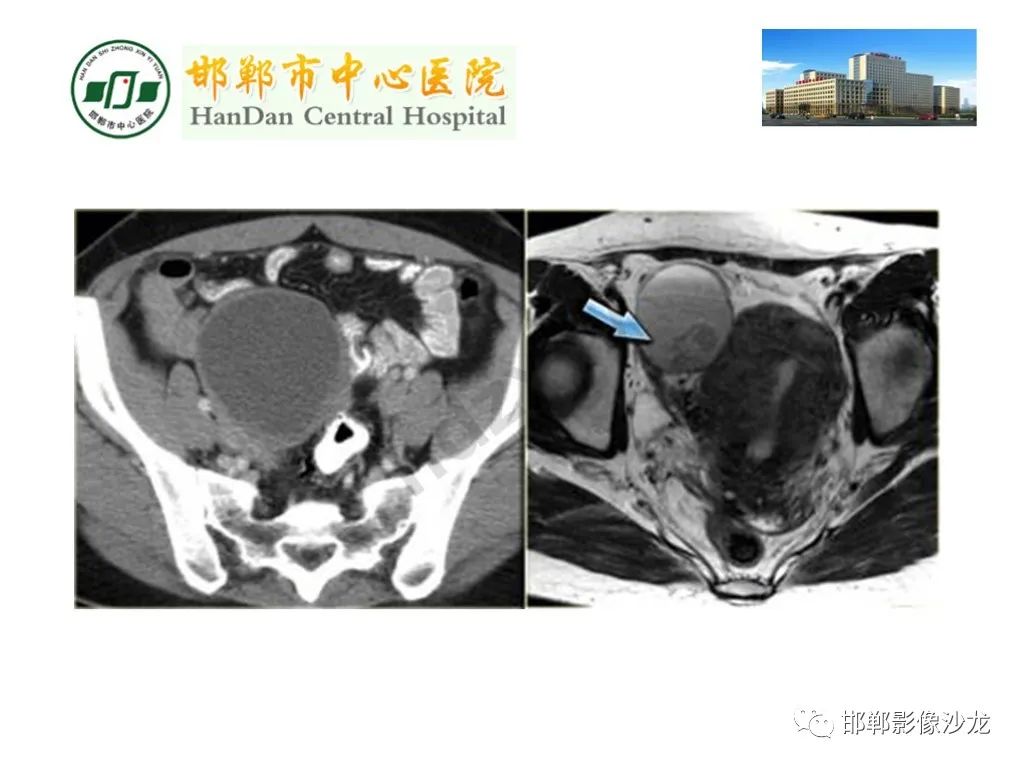 【PPT】卵巢非肿瘤性病变的影像诊断-28