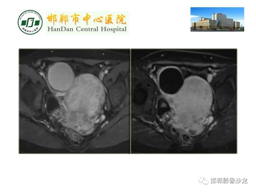 【PPT】卵巢非肿瘤性病变的影像诊断-29