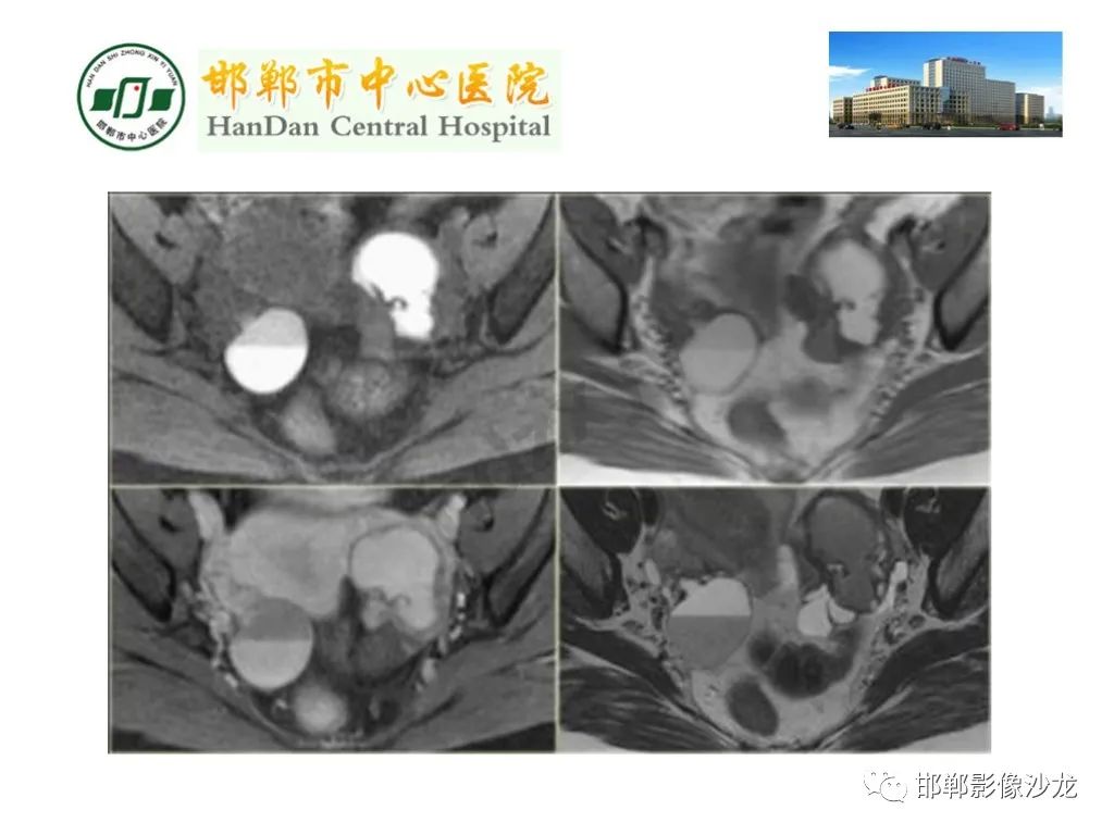 【PPT】卵巢非肿瘤性病变的影像诊断-30