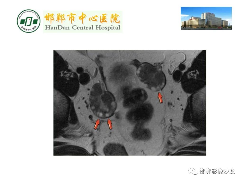 【PPT】卵巢非肿瘤性病变的影像诊断-32