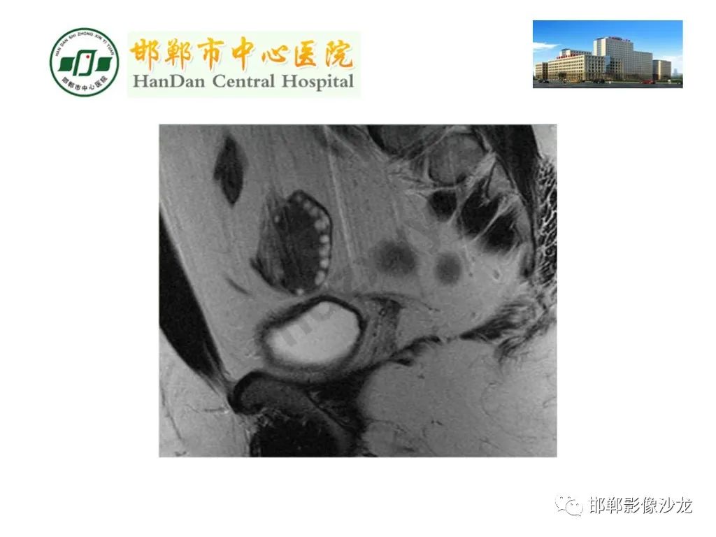 【PPT】卵巢非肿瘤性病变的影像诊断-33