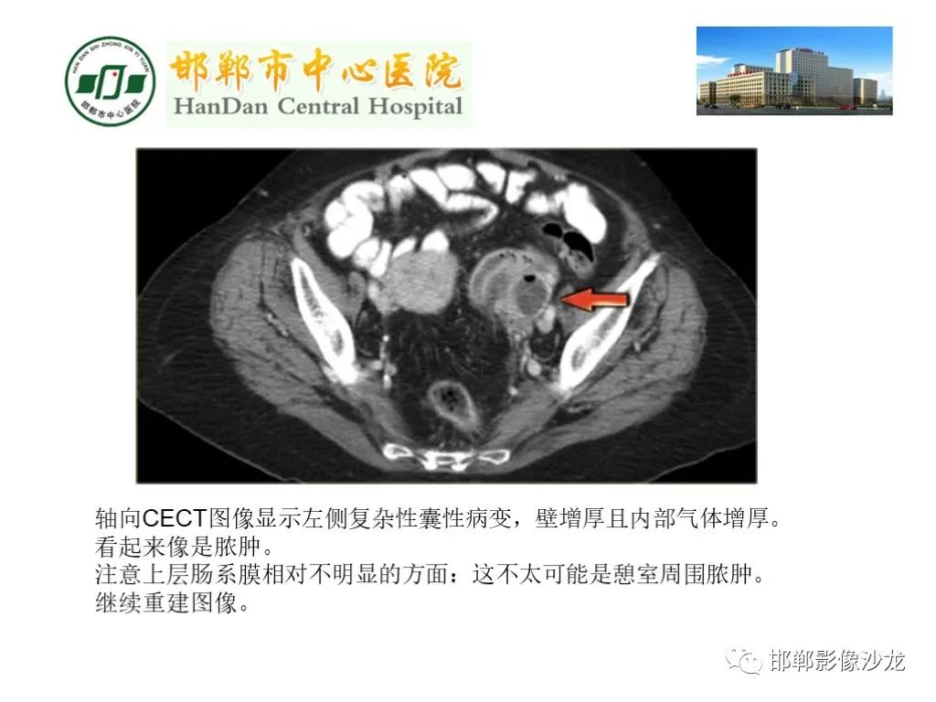 【PPT】卵巢非肿瘤性病变的影像诊断-35