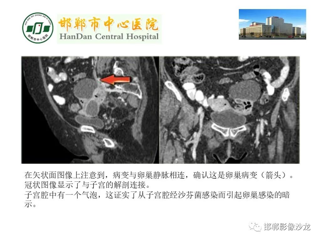 【PPT】卵巢非肿瘤性病变的影像诊断-36