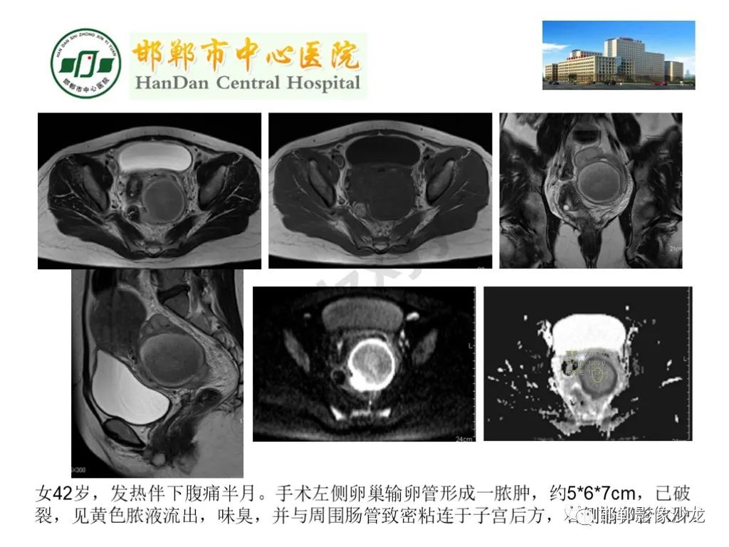 【PPT】卵巢非肿瘤性病变的影像诊断-37
