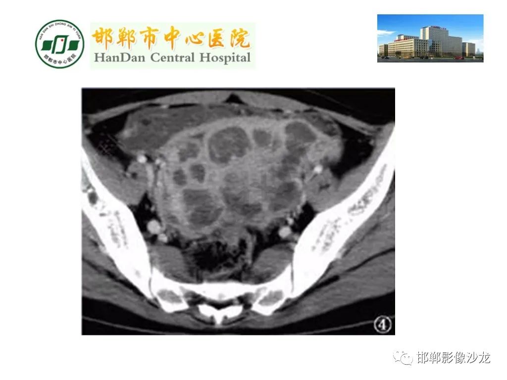 【PPT】卵巢非肿瘤性病变的影像诊断-38
