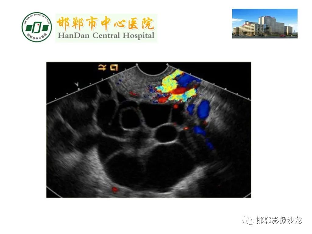 【PPT】卵巢非肿瘤性病变的影像诊断-40