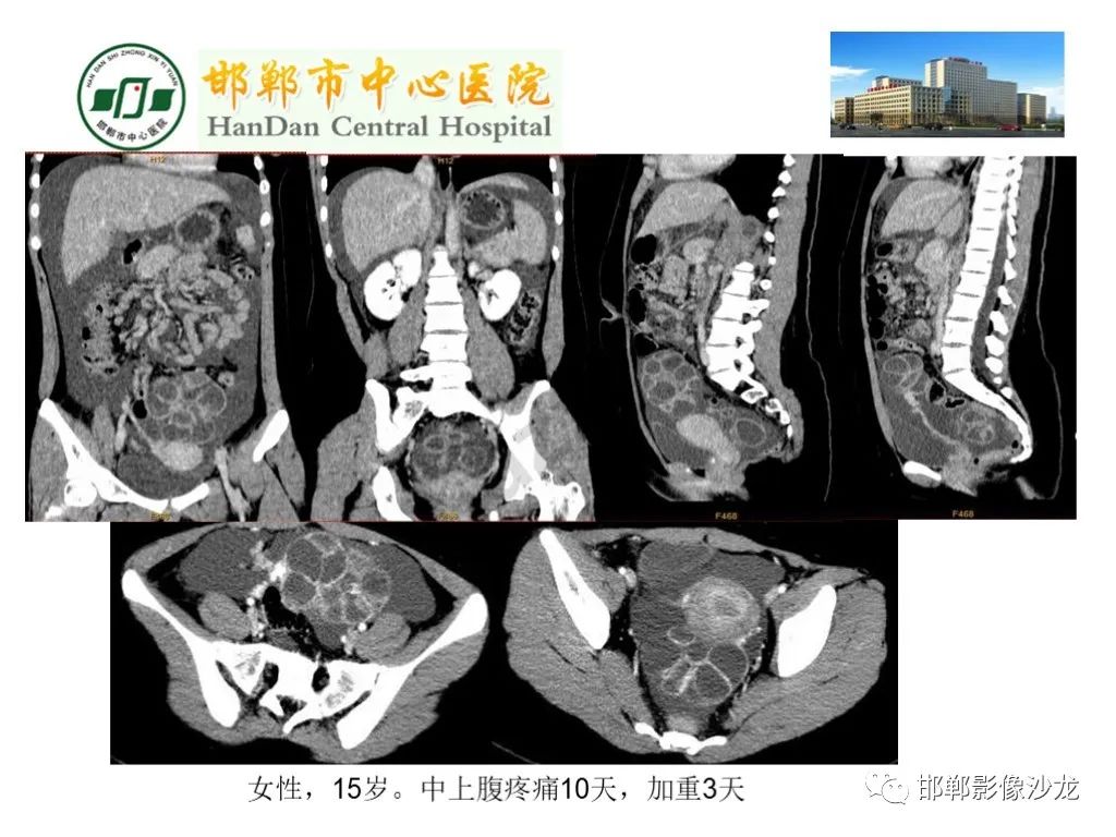 【PPT】卵巢非肿瘤性病变的影像诊断-41