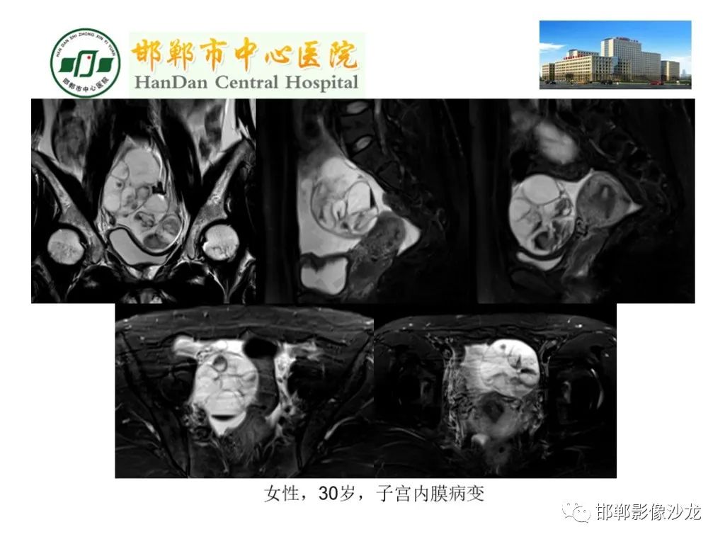 【PPT】卵巢非肿瘤性病变的影像诊断-43