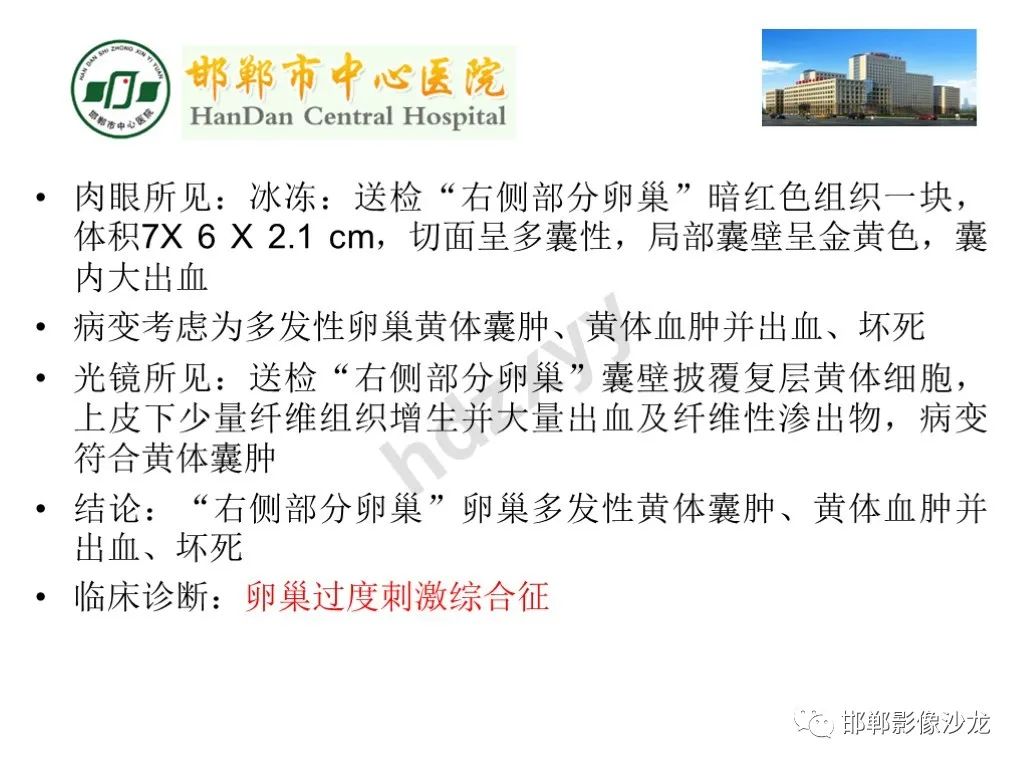 【PPT】卵巢非肿瘤性病变的影像诊断-42