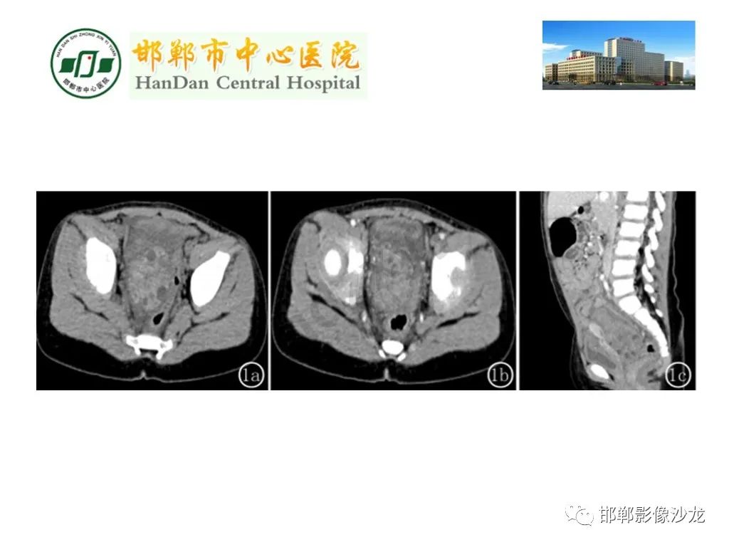 【PPT】卵巢非肿瘤性病变的影像诊断-46