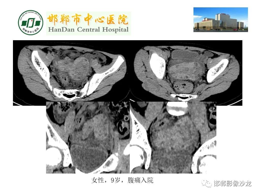 【PPT】卵巢非肿瘤性病变的影像诊断-47
