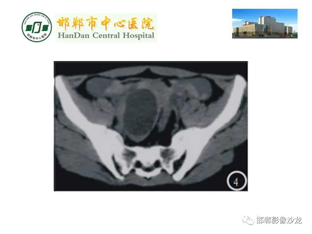 【PPT】卵巢非肿瘤性病变的影像诊断-50