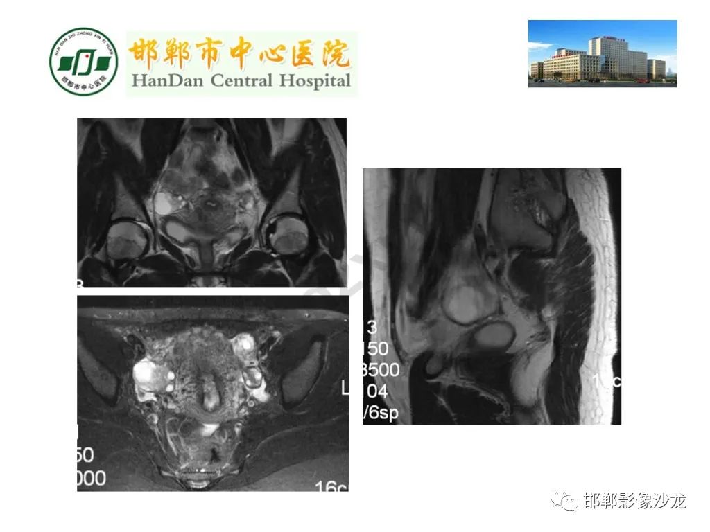 【PPT】卵巢非肿瘤性病变的影像诊断-51