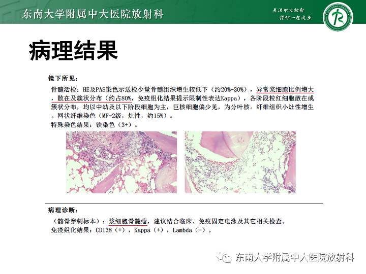 【PPT】多发性骨髓瘤-3