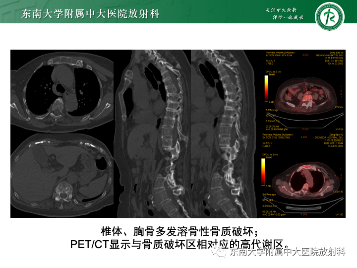 【PPT】多发性骨髓瘤-4