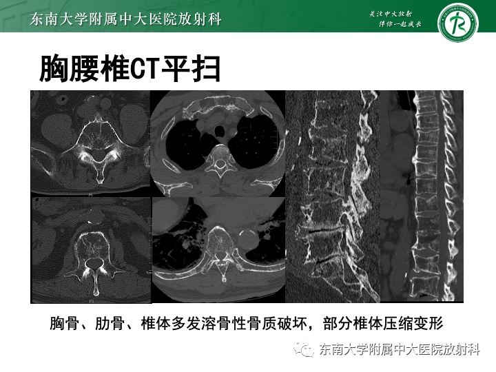 【PPT】多发性骨髓瘤-1