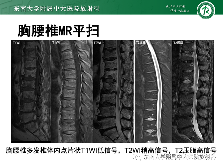 【PPT】多发性骨髓瘤-2
