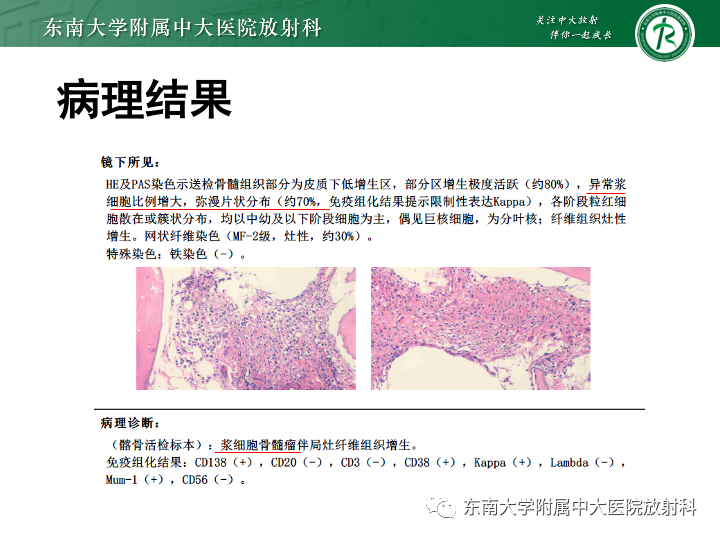 【PPT】多发性骨髓瘤-5