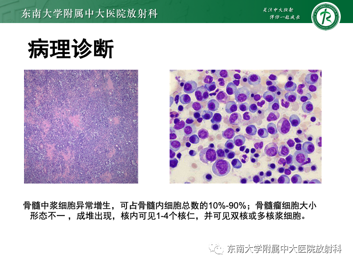 【PPT】多发性骨髓瘤-15