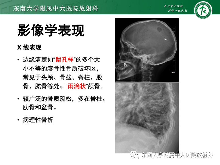【PPT】多发性骨髓瘤-18