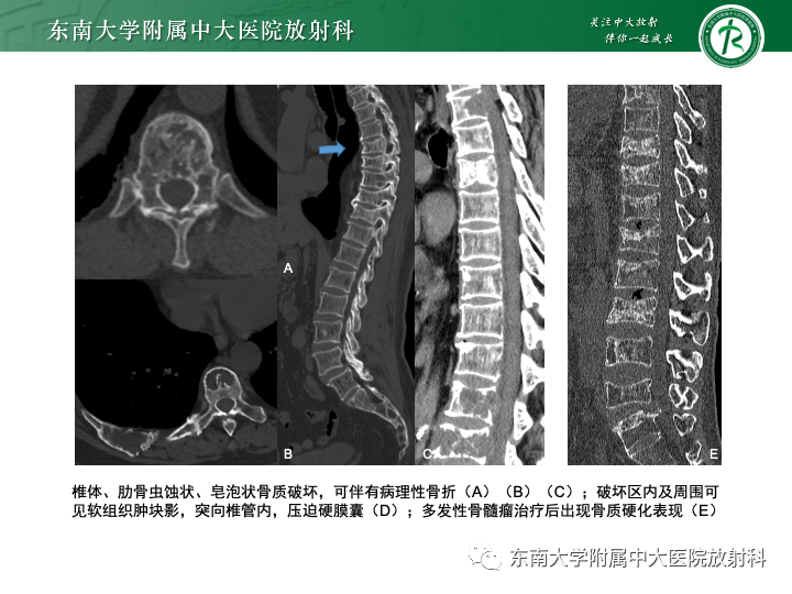 【PPT】多发性骨髓瘤-20