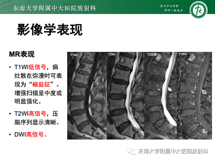 【PPT】多发性骨髓瘤-21