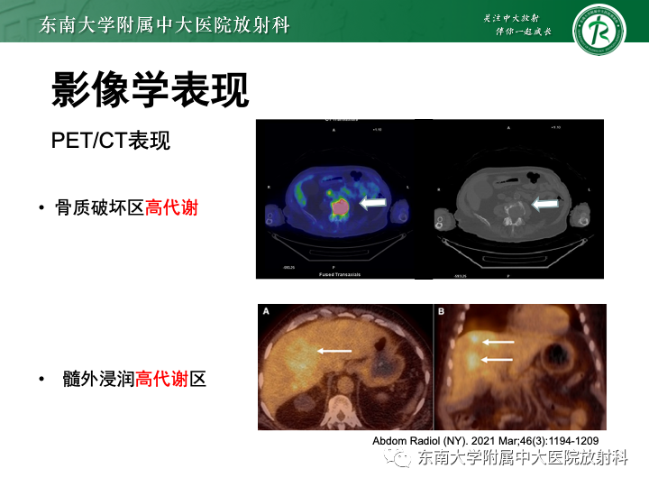 【PPT】多发性骨髓瘤-22