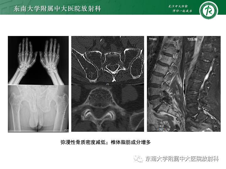 【PPT】多发性骨髓瘤-25