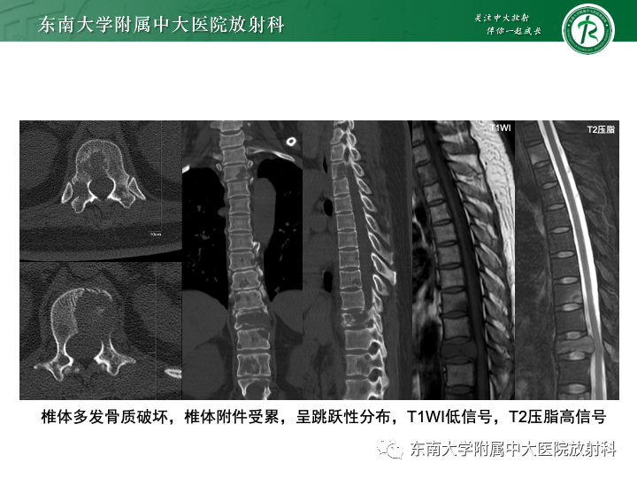 【PPT】多发性骨髓瘤-28