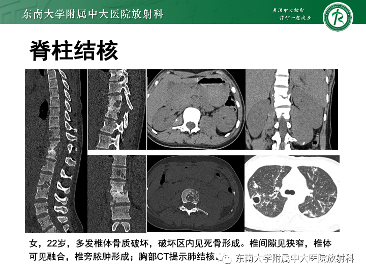 【PPT】多发性骨髓瘤-31