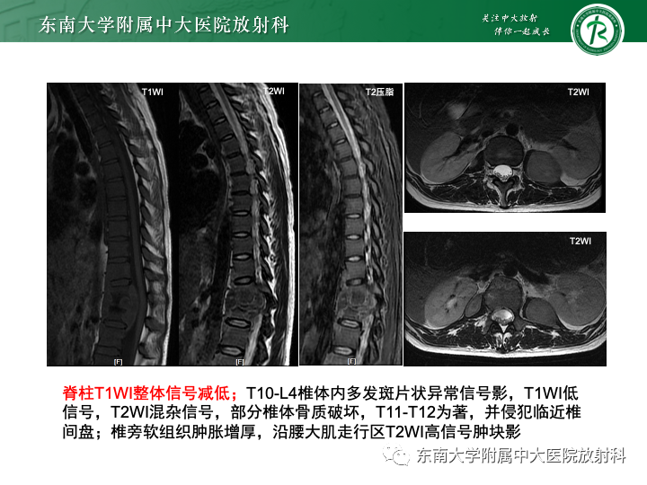 【PPT】多发性骨髓瘤-32