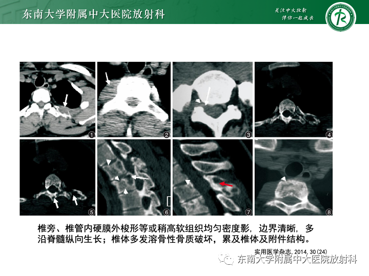 【PPT】多发性骨髓瘤-35