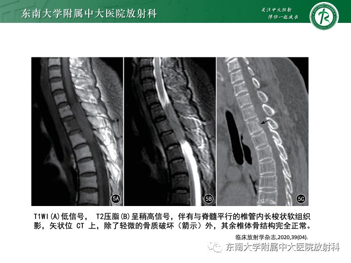 【PPT】多发性骨髓瘤-36