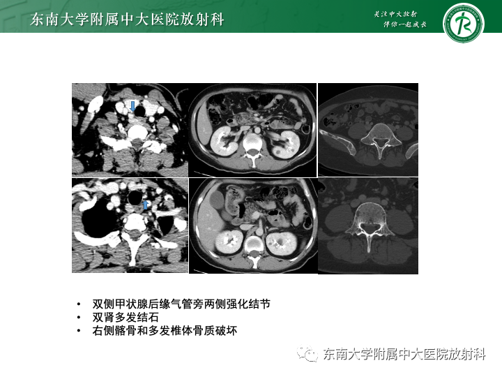 【PPT】多发性骨髓瘤-38
