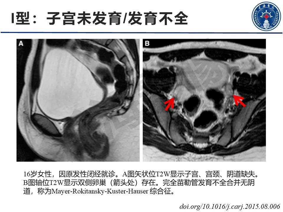 【PPT】子宫畸形的分类及MR诊断-8