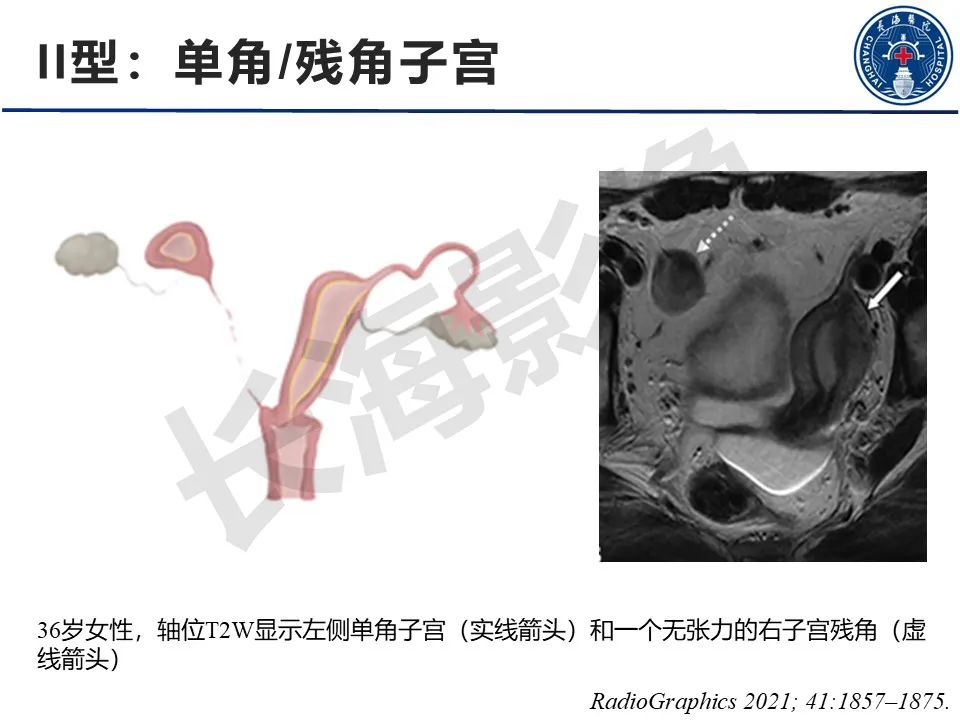 【PPT】子宫畸形的分类及MR诊断-10