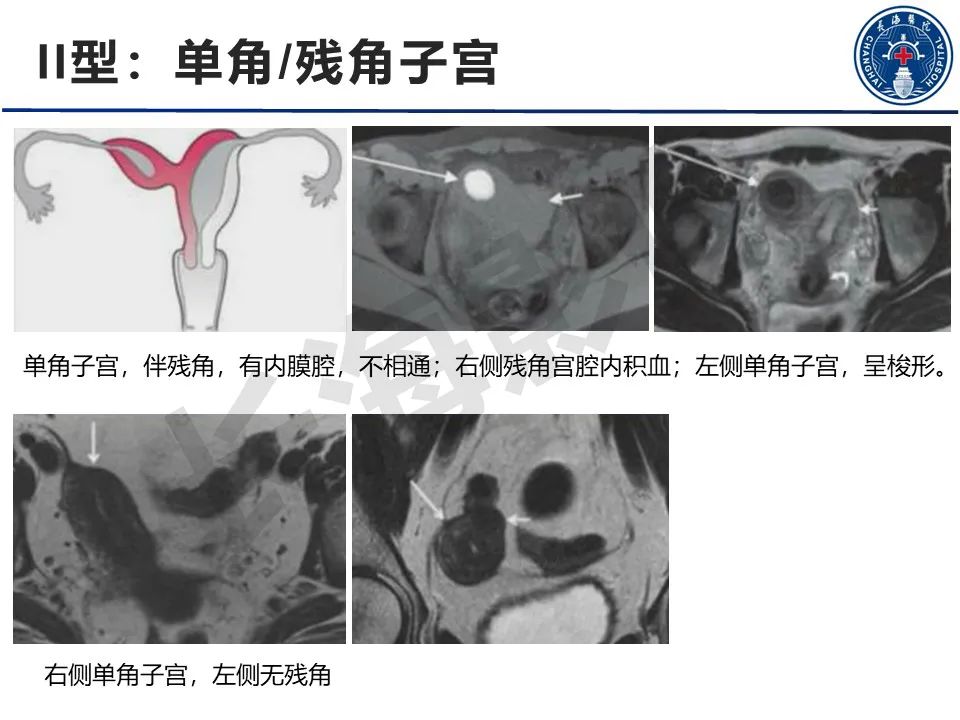 【PPT】子宫畸形的分类及MR诊断-11