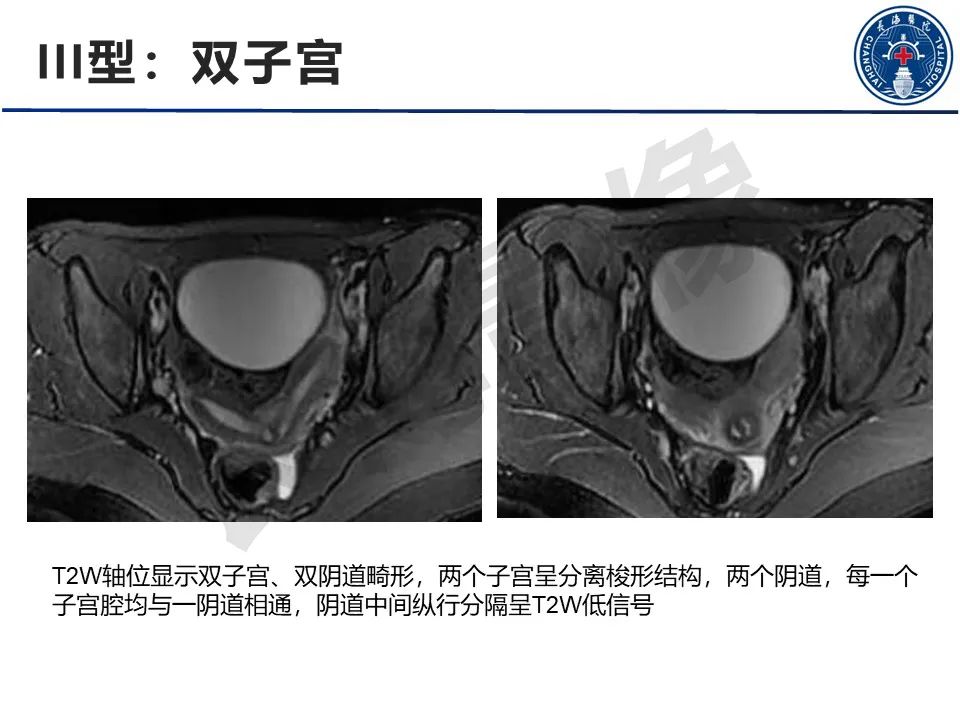 【PPT】子宫畸形的分类及MR诊断-13